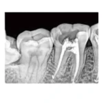 Dental sensörle alınmış ağız içi radyografi