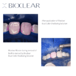 Bioclear Dual Color ve Blaster klinik uygulaması