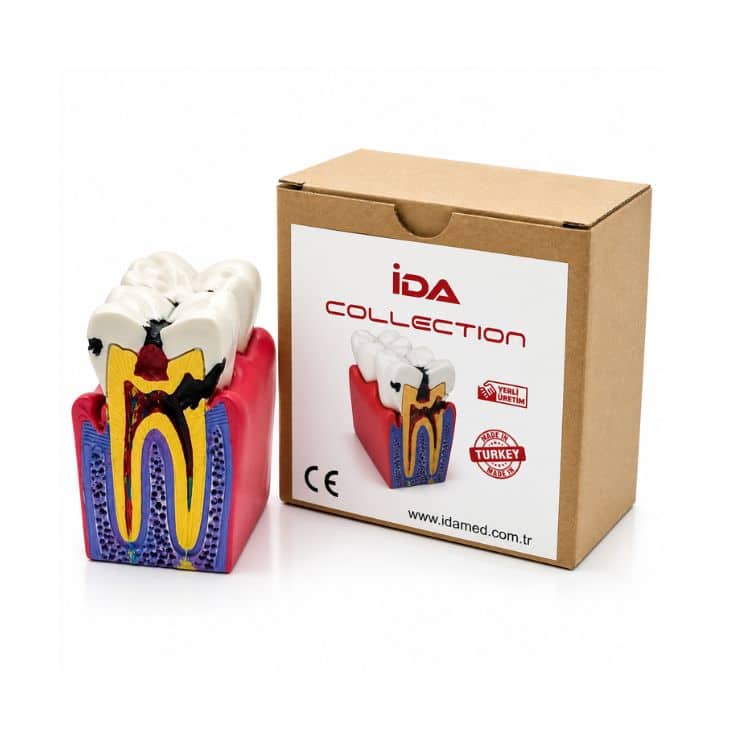 Diş Çürüğü Eğitim Modeli (Gerçekçi Dental Eğitim Maketi) ürün görseli