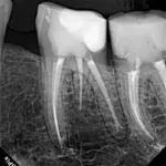 Eighteeth Nanopix RVG X Ray Sensörü Size.1 NanoPix Intraoral X-ray Sensor ürün görseli