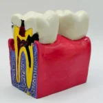 Diş Çürüğü Eğitim Modeli (Gerçekçi Dental Eğitim Maketi) ürün görseli