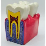 Diş Çürüğü Eğitim Modeli (Gerçekçi Dental Eğitim Maketi) ürün görseli