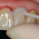 Ivoclar Vivadent- Liquid Strip Refill 1x2.5 gr ürün görseli