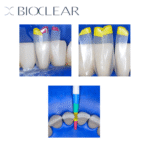 Bioclear BT matriks klinik uygulama örnekleri